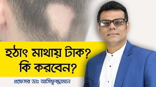 Alopecia Areata Treatment Bangla  Androgenetic Alopecia Treatment  হঠাৎ মাথায় টাক [upl. by Yarised825]