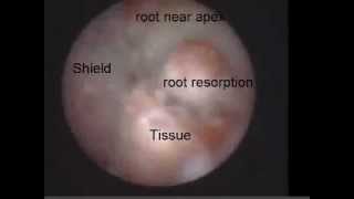 External Root Resorption 2 Viewed with the Perioscope [upl. by Bashemath]