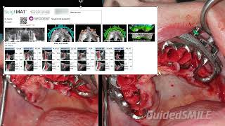 GuidedSMILE Dentate Natural Single Maxillary  Hamill [upl. by Ahtan438]