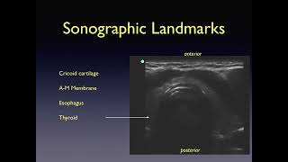 Emergency Ultrasound Guided Endotracheal Tube Confirmation [upl. by Ytsim]