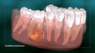 Dental Abcess  Why Root Canal Treatment Is Needed [upl. by Ahsimac]