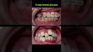 Braces evolution  2 years braces orthodontist dentist [upl. by Ynetruoc996]