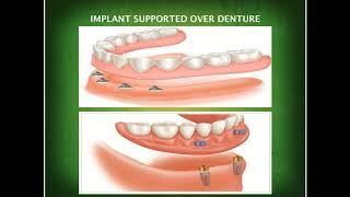 Introduction to Prosthodontics [upl. by Oehsen]