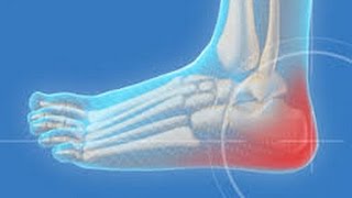 Heel Bruise Pain  Tendinitis Acupressure Solution Cure [upl. by Lindsay]