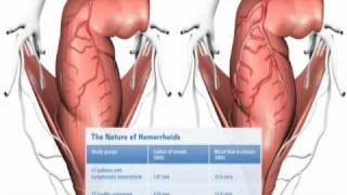 The Nature of Haemorrhoids [upl. by Elbys]