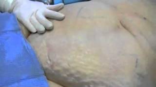 Actual Liposuction Procedure [upl. by Ocirne103]