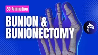 Bunion and Bunionectomy with Osteotomy  3D Animation [upl. by Graehme]