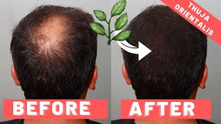 Thuja Orientalis For Hair Loss [upl. by Stochmal723]