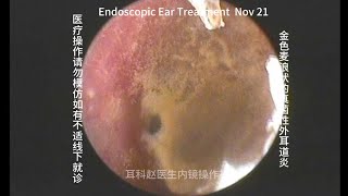 Ear wax removal Golden earwax fungus dry sheet cleaning 20241121 [upl. by Takara]