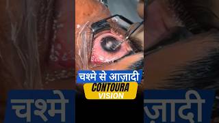 चश्मे से आज़ादी Contoura Vision के साथ [upl. by Anuayek]