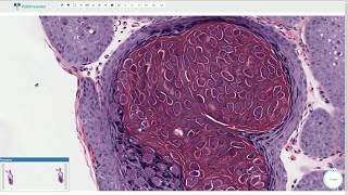 Molluscum Contagiosum  Histopathology [upl. by Blynn]