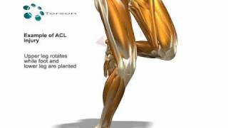 ACL Tear Sports Injury [upl. by Bogosian]