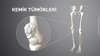 Kemik Tümörleri  Prof Dr Yakup YILDIRIM [upl. by Ibbetson]