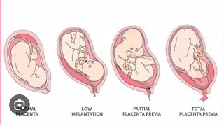 How to manage antepartum haemorrhage🚨😷drsaminakhurshidgynaecolog4661 [upl. by Dirrej]