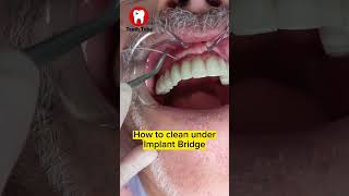 How to floss under Implant Bridge with superfloss flossing dentalcare dentalimplants shorts [upl. by Anaicilef]