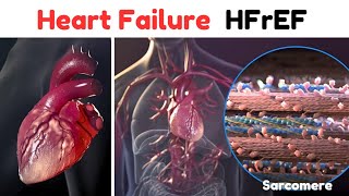 Heart Failure HFrEF medical animation video  cardiology [upl. by Shirlene987]