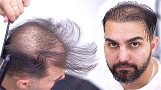 Barbers Magic on a Live Model 👨‍🦲✂️ I Transforming Thinning Hair [upl. by Nirtiac]