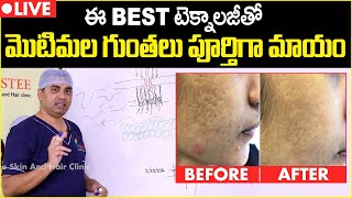 మొటిమల గుంతలు పూర్తిగా పోవాలంటే  CO2 Laser Treatment For Acne Scars  Celestee Skin And Hair Clinic [upl. by Novaelc]