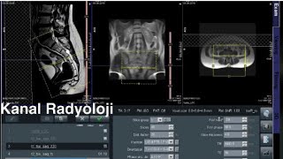 Koksiks MR Nasıl Çekilir KANAL RADYOLOJİ MR Çekmeyi Öğreniyorum Siemens Magnetom Essenza [upl. by Allegna]