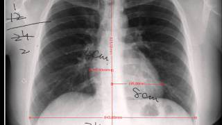 Chest xray Cardiothoracic Ratio CARDIAC SIZE  Cardiomegaly [upl. by Helsa336]