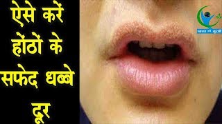 होठों से सफ़ेद धब्बे दूर करने के ये हैं आसान घरेलू उपाय…  Home Remedies for White Spots on Lips [upl. by Ennaj]