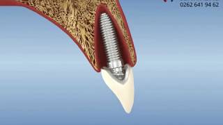 Diş çekiminden sonra hemen implant uygulaması  immediate implant [upl. by Kcorb]