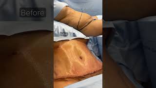 High Definition Tummy Tuck [upl. by Ecille338]