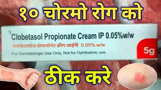 Clobetasol Cream use For एग्जिमा एलर्जी Damataitisskin rashes  soriasis  Review in hindi [upl. by Llevart]