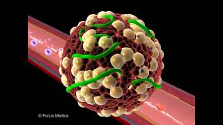 Renal artery stenosis  Nephrology [upl. by Shannan]