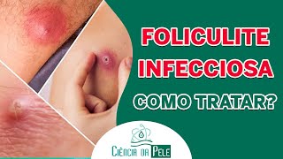 Como Tratar Foliculite Infecciosa  Saiba Tudo Sobre Essa Condição [upl. by Scotti]