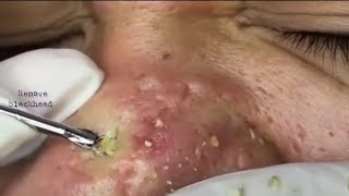 Acne Treatment Blackhead Removal on his nose Remove Blackhead removeblackhead [upl. by Alita747]