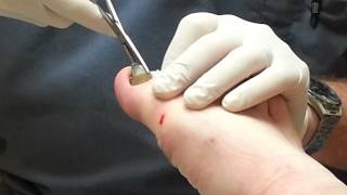 Toenail removal part 2 [upl. by Otilegna]