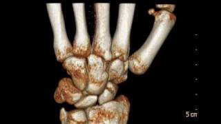 CTTC Multislice  Wrist Fracture  Fratura Punho  scaphoid [upl. by Grimona]