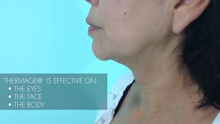 Thermage Skin Tightening Treatment [upl. by Thetisa310]