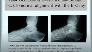 HyProCure® Before amp After TaloTarsal Stabilization [upl. by Anilocin]