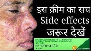 The Shoking Truth Of Betnovate N Cream Betnovate n cream Review and Side effects [upl. by Warga666]