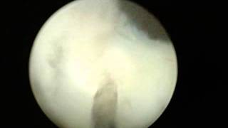 Holmium Laser enucleation of the Prostate Guys Hospital [upl. by Dlaregztif223]