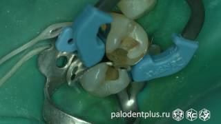 Rubberdam case 072 II Class Palodent Plus 4K [upl. by Nodyarb]