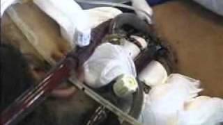 Extracorporeal Membrane Oxygenation ECMO [upl. by Aketahs]