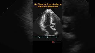 Subvalvular Aortic Stenosis cardiology echocardiography shorts echocardiogram aorticstenosis [upl. by Atthia]