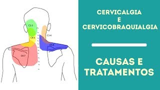 Cervicalgia e Cervicobraquialgia Causas e Tratamentos [upl. by Jenks910]