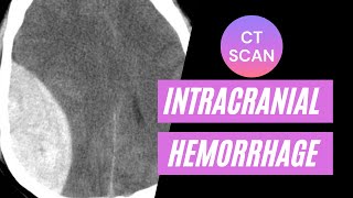 CT imaging of intracranial hemorrhage For medical students residents and clinicians [upl. by Ellita428]