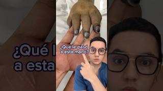 ¿Qué le pasó a esta mano Acrocianosis Dr William Guerrero medicina shorts [upl. by Hite]