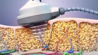 Ultrashape Focused Ultrasound Fat Removal Treatment Principle [upl. by Aneehsor577]