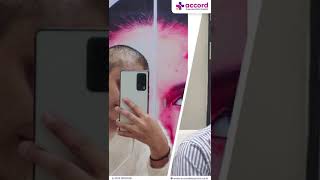 Success Story Alopecia Areata Treatment  Patient Testimonial  Dr Sonali Gupta [upl. by Kalli397]