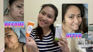 How I cleared my skin for 3 months epiduo gel forte Azelaic acid [upl. by Monie]