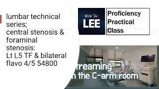 Transforaminal injection technical series part 6 Lt L5 TF amp bilateral flavo 45 54800 [upl. by Harri]