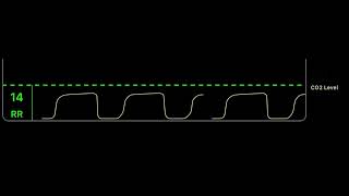 CO2 Capnography monitoring [upl. by Dexter643]