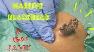 Massive 15 year Blackhead Dr Khaled Sadek LipomaCystcom [upl. by Enialehs]