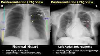 Chest XRay Heart Normal Vs Abnormal Image Appearances  Cardiac Diseases On Radiography CXR [upl. by Oberstone934]